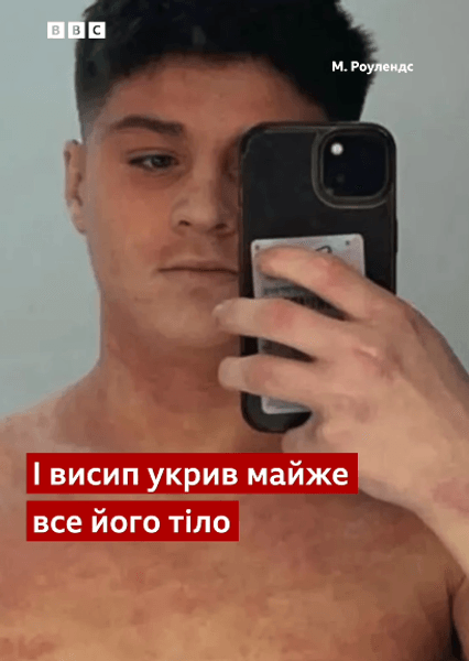 Чому відмова від мазі при екземі може призвести до неможливості ходити: синдром відміни стероїдів 2 Чому відмова від мазі при екземі може призвести до неможливості ходити: синдром відміни стероїдів 2